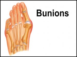 bunions6