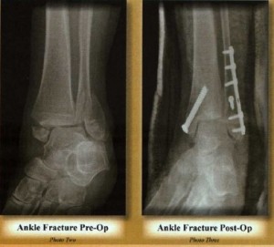 2_3_Ankle Fx Xrays
