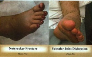 5_6_Nutcracker_Subtalar