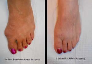 Best Livonia Bunion Surgeons