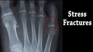 top of foot hairline fracture