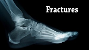 broken foot