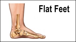 treat flat feet
