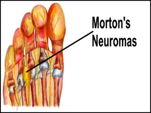morton's neuroma