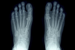 Arthritic Foot Care
