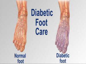 proper diabetic foot care