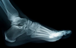 rheumatoid arthritis