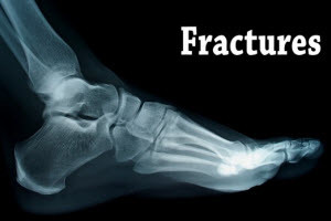 broken foot