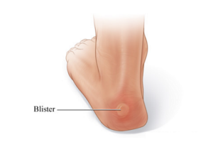 painful foot blisters