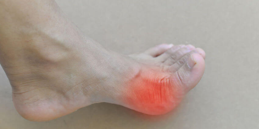 managing gout