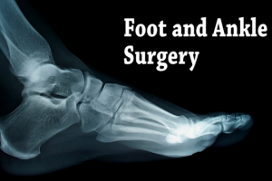 recovering from foot surgery