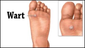 Plantar Warts