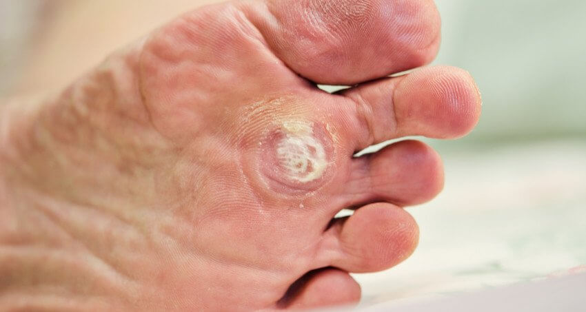 Warts on feet discount
