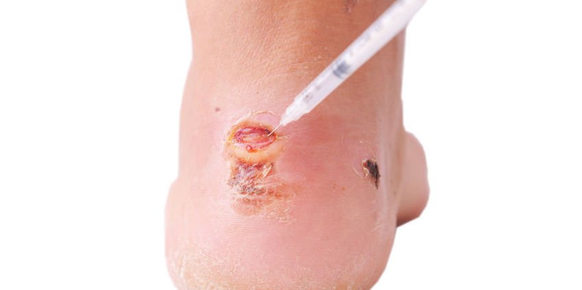 blisters on your feet