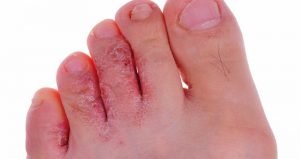 Unique Cures for Athletes Foot