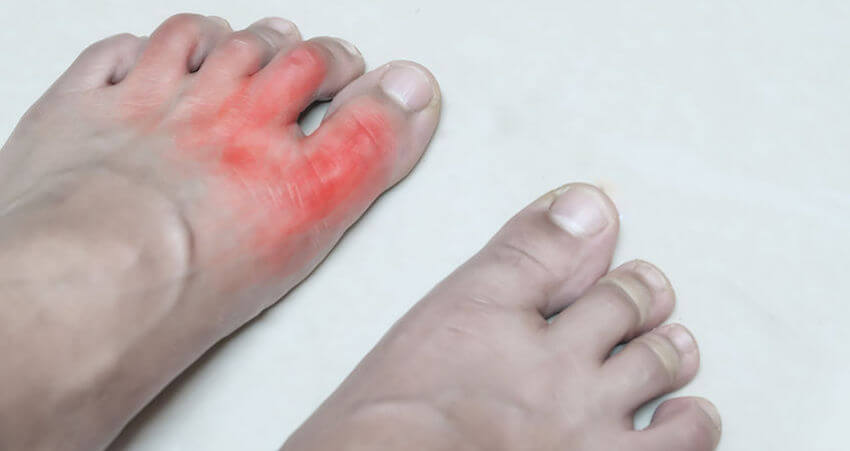 rheumatoid arthritis in the feet