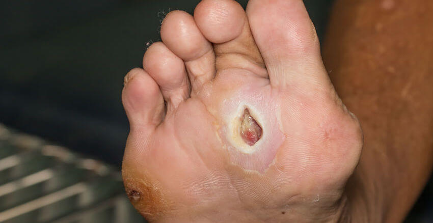 help foot wounds heal
