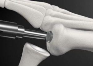 Synthetic Cartilage Implant