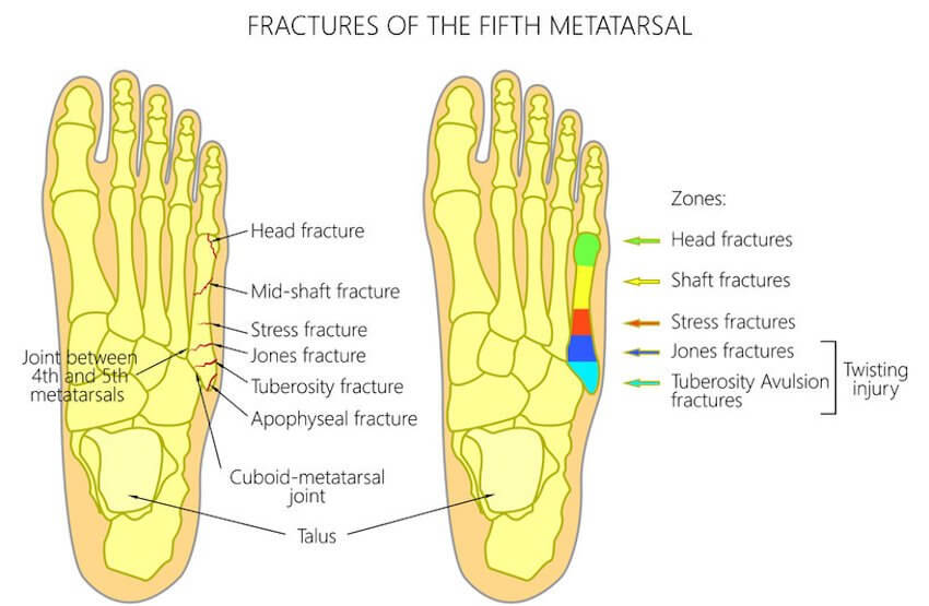 Foot Stress Fractures