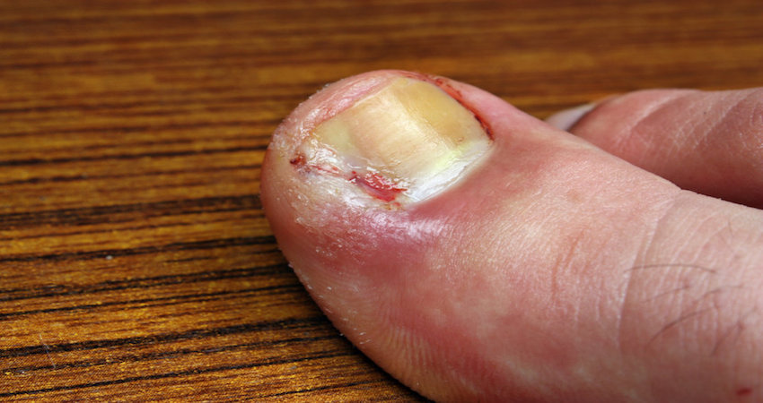 Cure an Ingrown Toenail