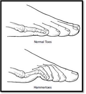 Hammer Toe