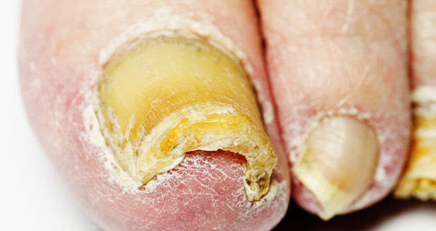 Toenail Fungus Treatments When To See The Doctor