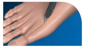 Cartiva Surgery