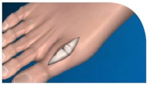 Cartiva Surgery