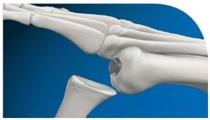 Cartiva Surgery 3