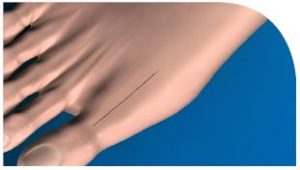 Cartiva surgery 4