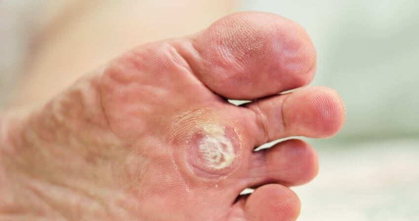 Reduce Risk for Plantar Warts