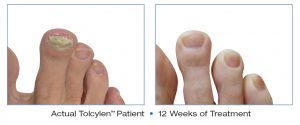 nail fungus treatment 2