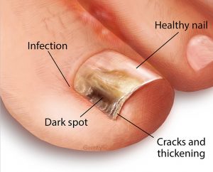Fungal Nail Treatment | Michigan Tolcylen Providers | Foot Healthcare Associates