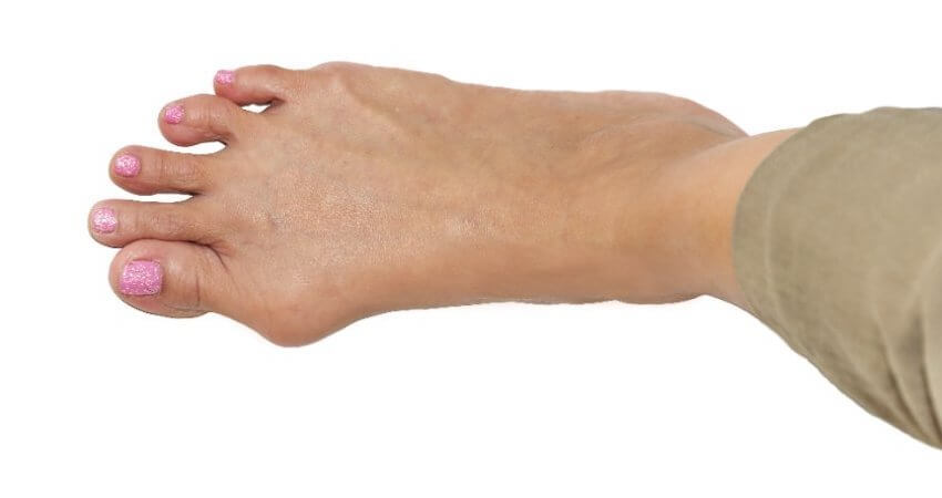 Functional Hallux Limitus