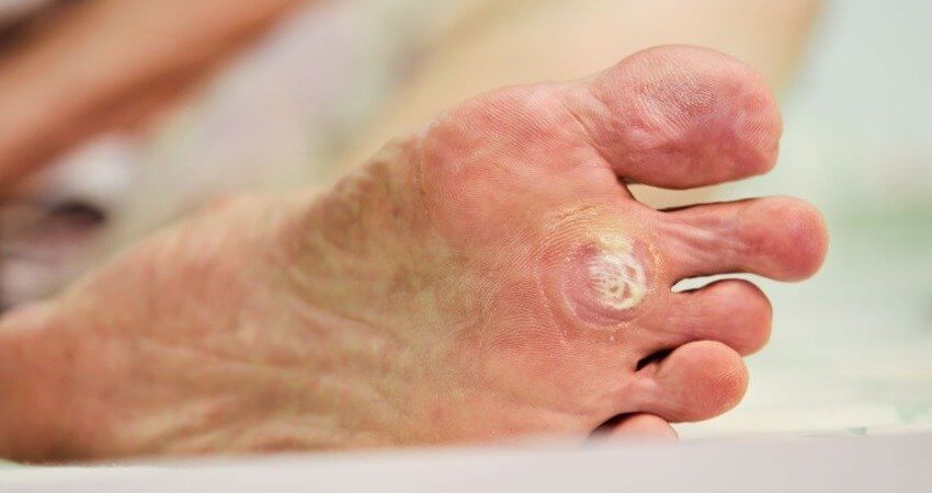 Unique and Promising Treatment for Resistant Plantar Warts