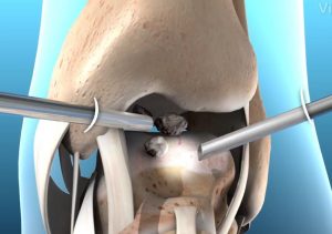 arthroscopy incisions