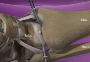 arthroscopic incisions