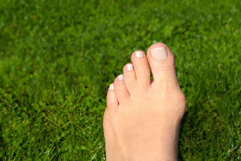 Bunion Surgery or Treatment