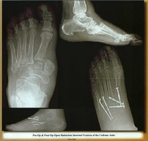 Best Novi Livonia Southfield Foot surgery