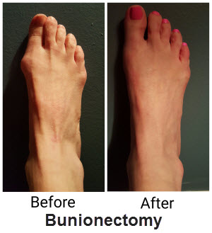 Livonia Best Bunion Surgeons