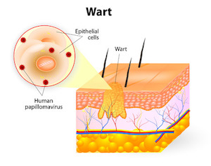 Unique and Promising Treatment for Resistant Plantar Warts