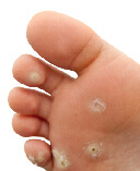 plantar warts