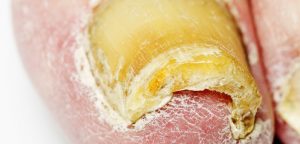 what causes thick toenails