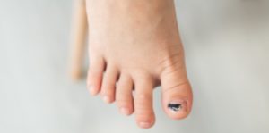 causes of black toenails