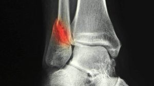 broken ankle