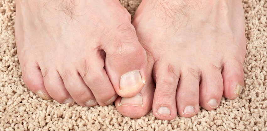 big toe arthritis