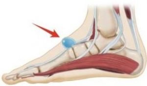 ganglion cyst on foot