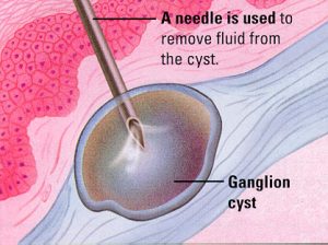 foot cyst aspiration