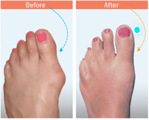 befor and after mini bunionectomy