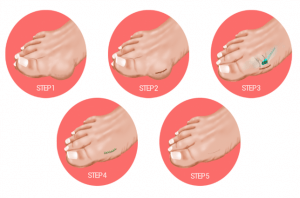 mini bunionectomy steps